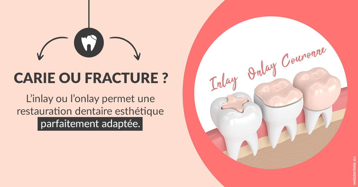 https://dr-olivier-percheron.chirurgiens-dentistes.fr/T2 2023 - Carie ou fracture 2