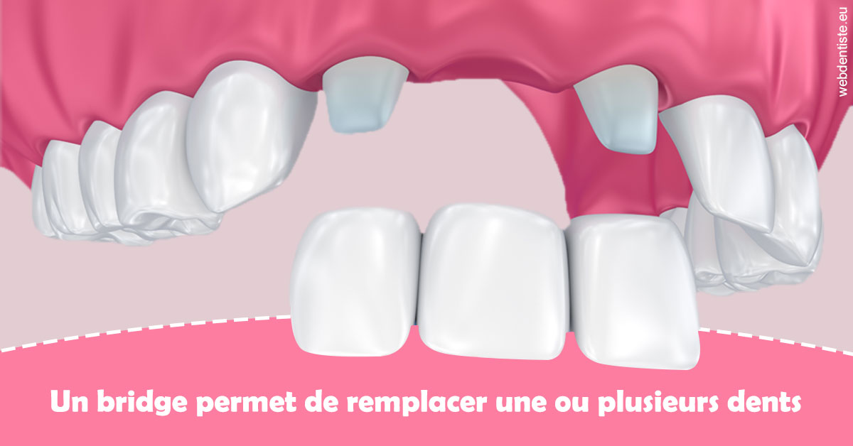 https://dr-olivier-percheron.chirurgiens-dentistes.fr/Bridge remplacer dents 2