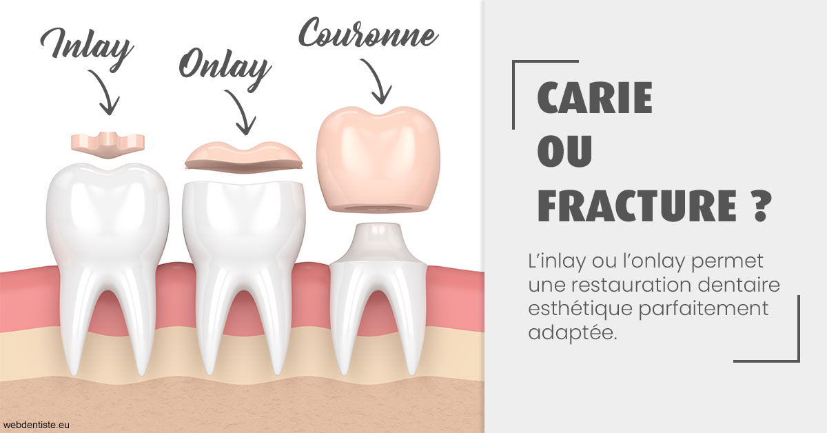 https://dr-olivier-percheron.chirurgiens-dentistes.fr/T2 2023 - Carie ou fracture 1