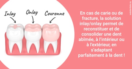 https://dr-olivier-percheron.chirurgiens-dentistes.fr/L'INLAY ou l'ONLAY 2