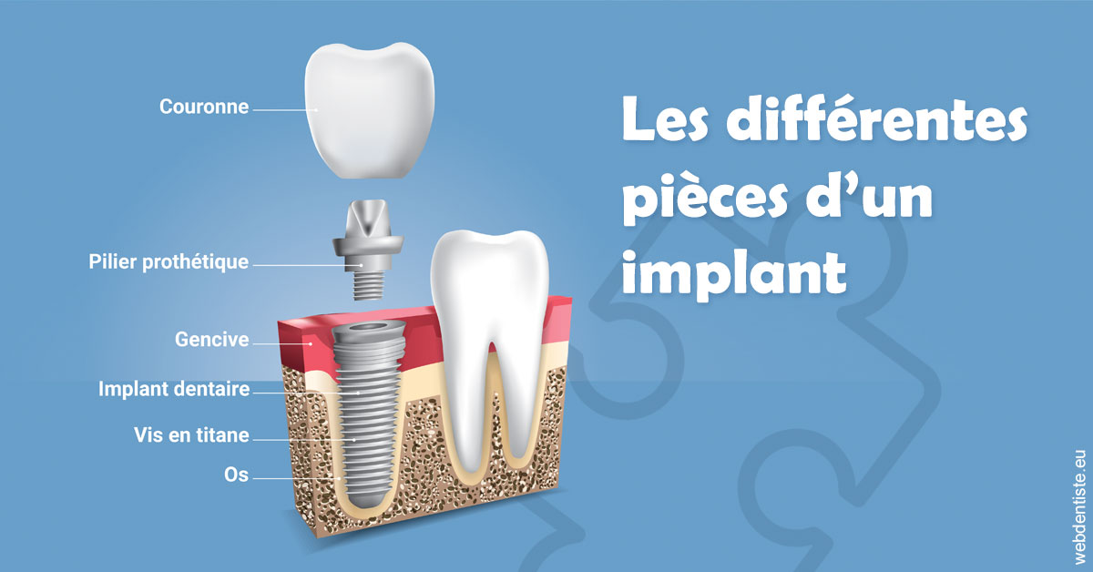 https://dr-olivier-percheron.chirurgiens-dentistes.fr/Les différentes pièces d’un implant 1